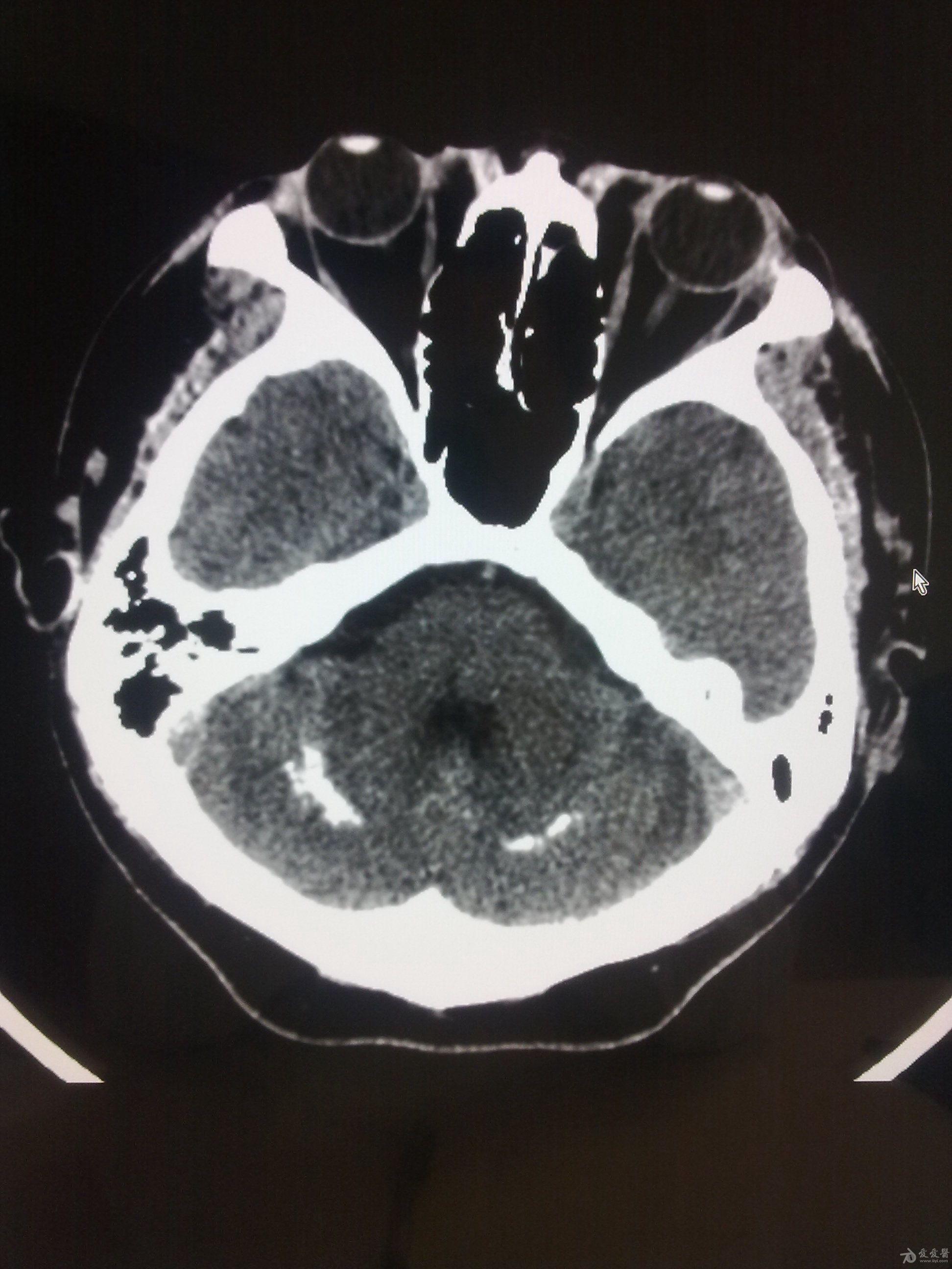 病例23颅内多发对称钙化甲状旁腺功能低下