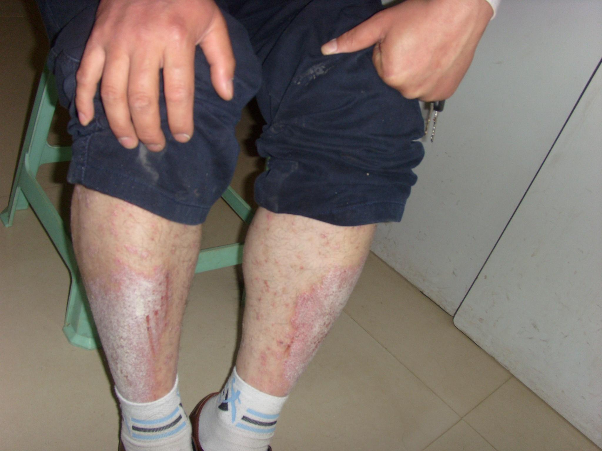 看图诊断治疗春季皮肤病病例征集