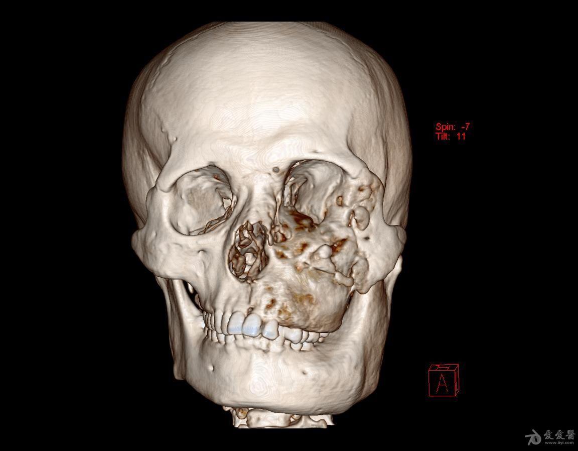 男性头颅ct三维