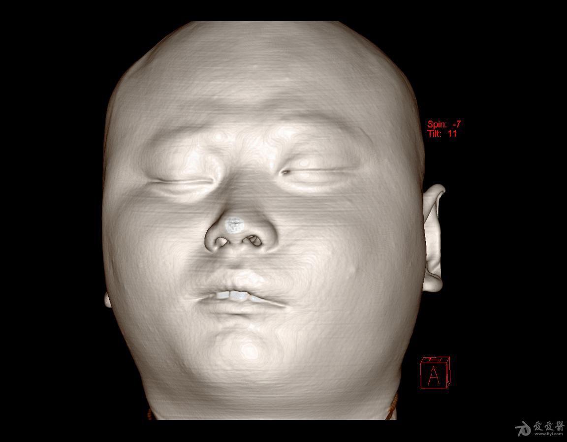 男性头颅ct三维