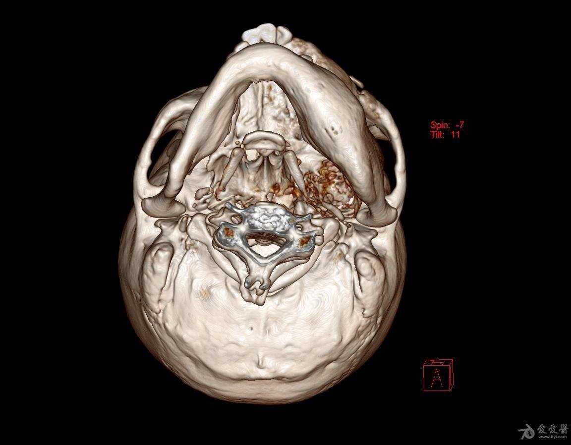 男性头颅ct三维