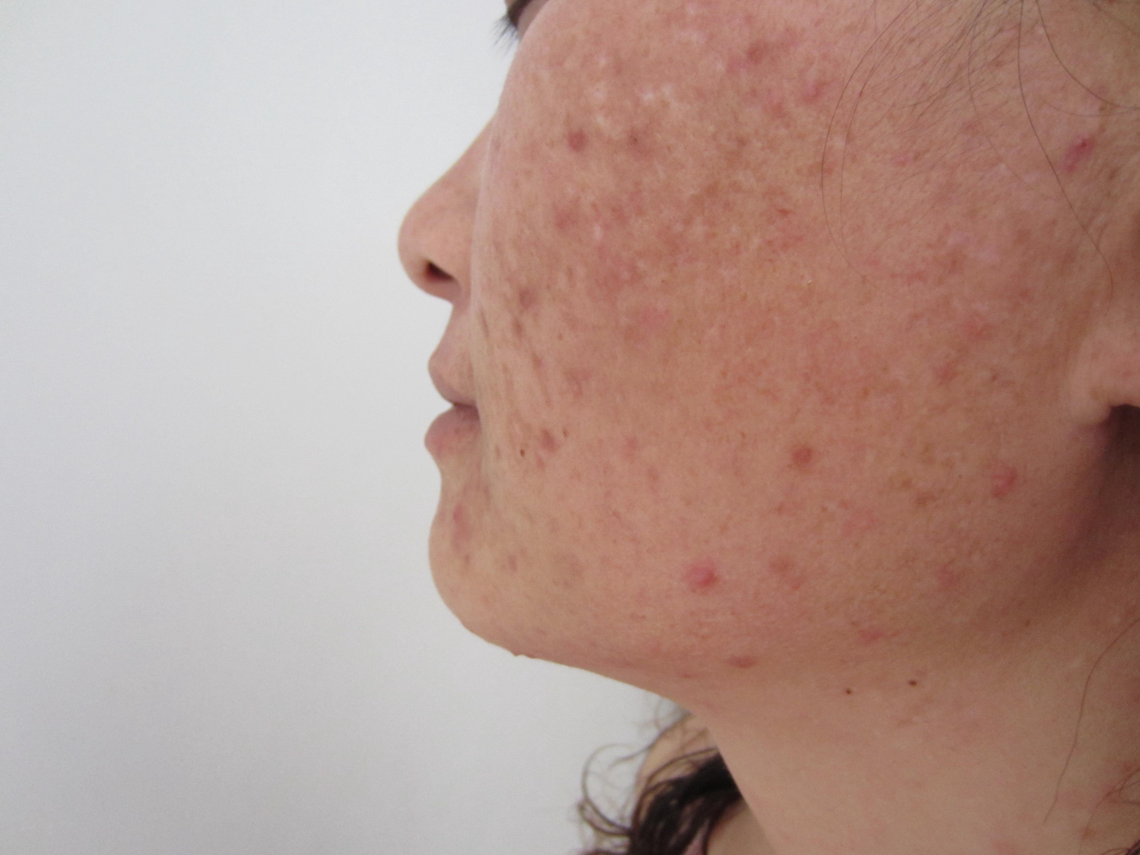 治了很多年的青春痘变痤疮有什么方法