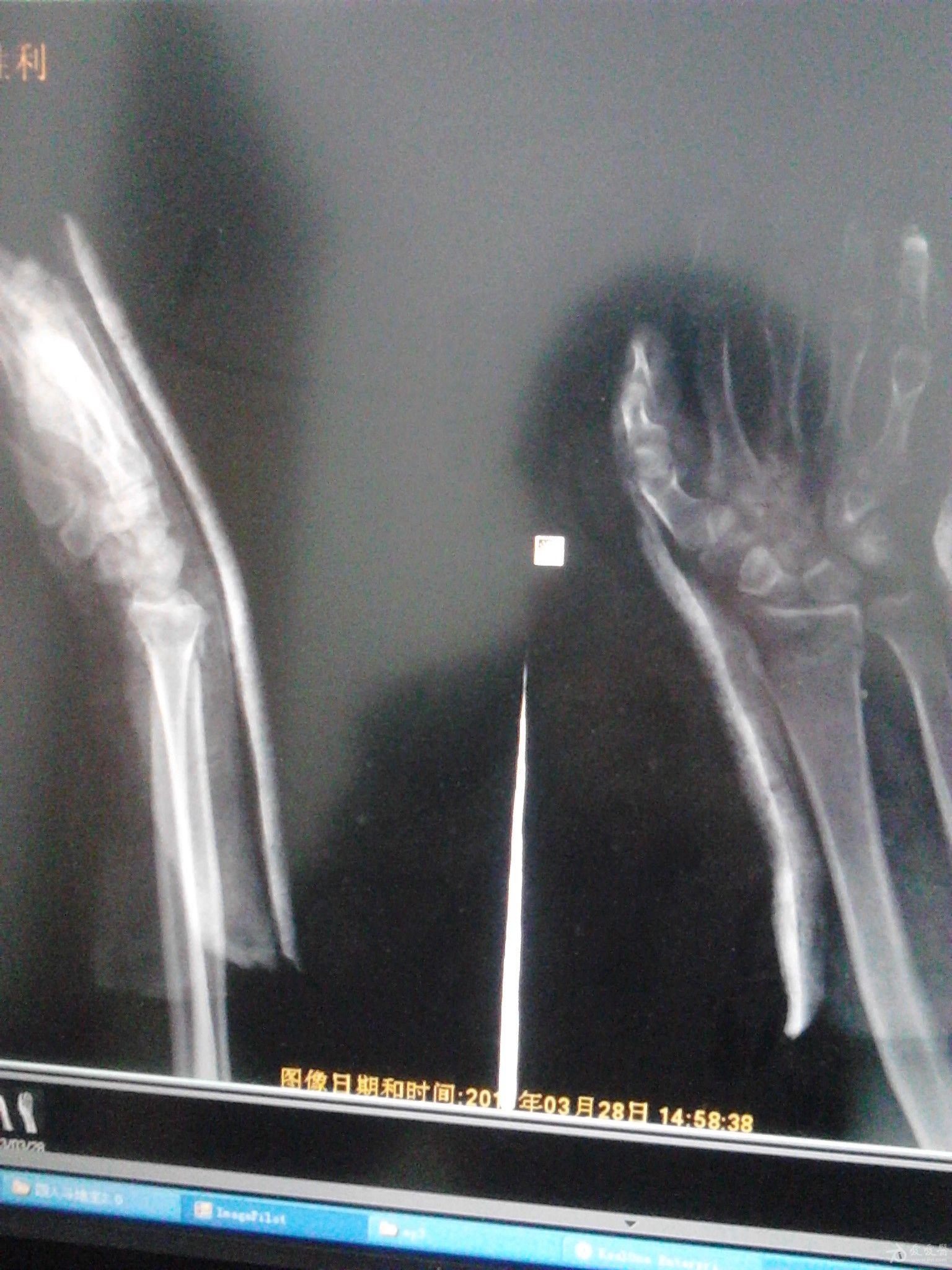 前天复位的一例克雷斯骨折复位后的片子,看的难受.