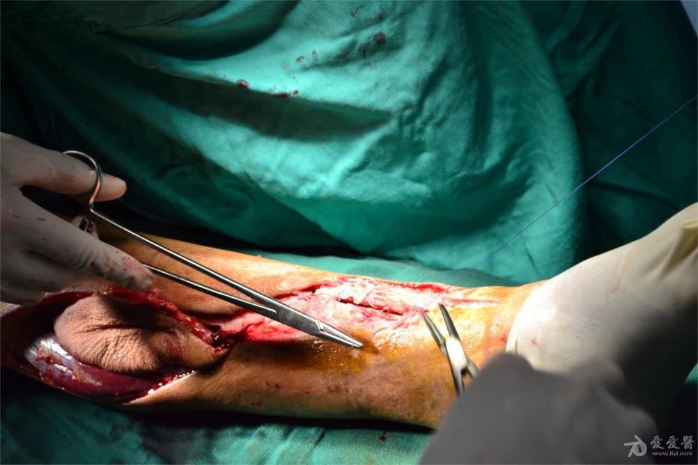 左胫腓骨开放性骨折内固定术后20天术后切口周围红肿