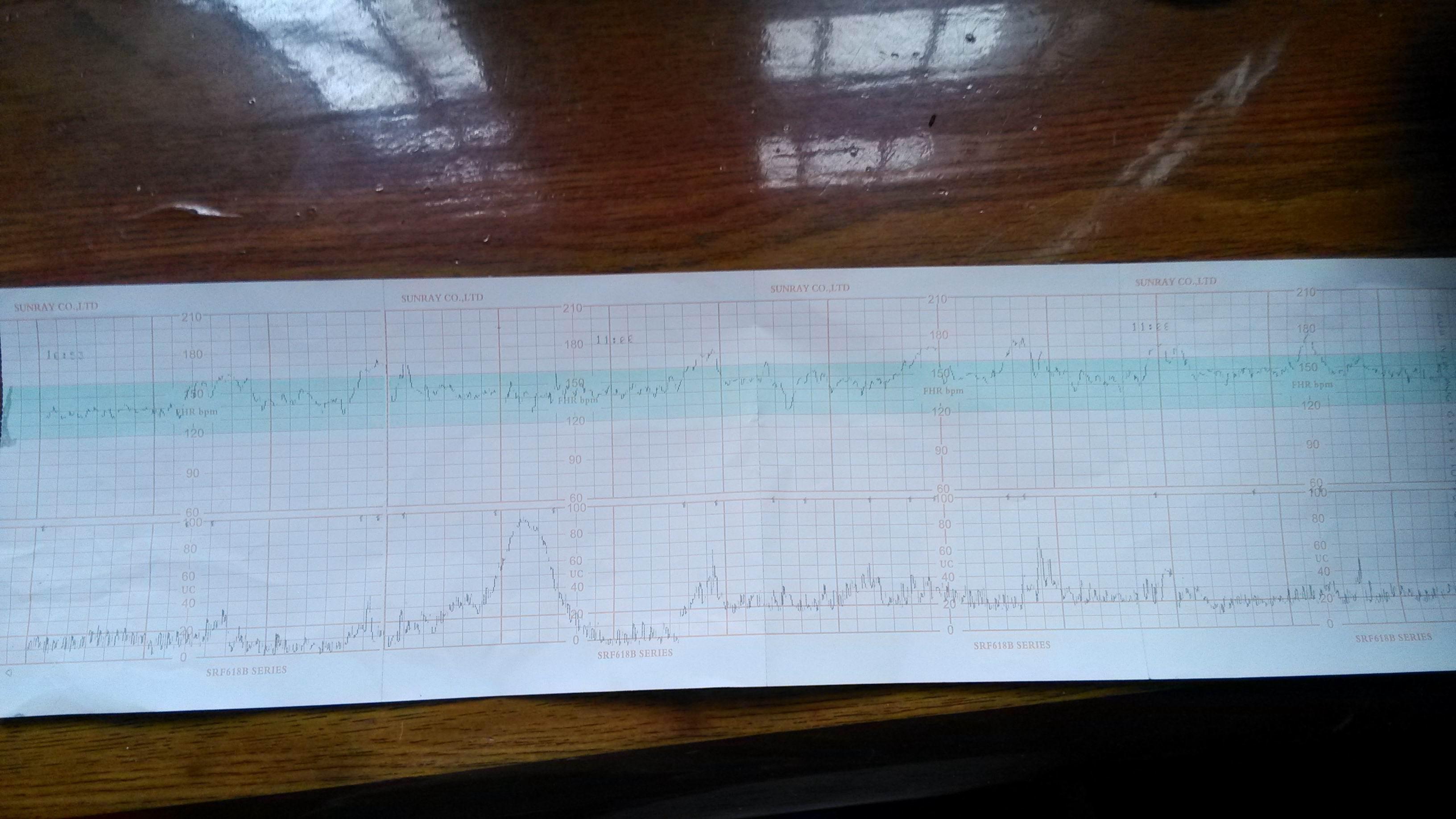 胎心監護圖求解答