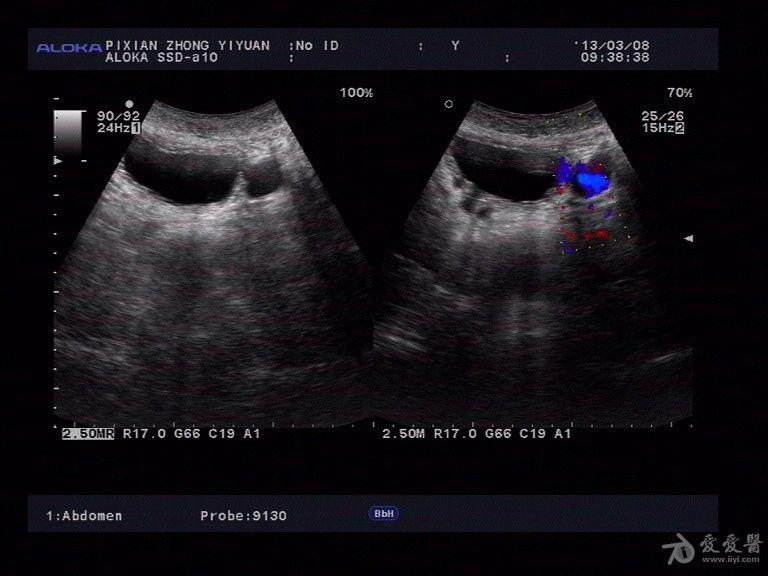 膀胱憩室两例 - 超声医学讨论版 - 爱爱医医学论坛