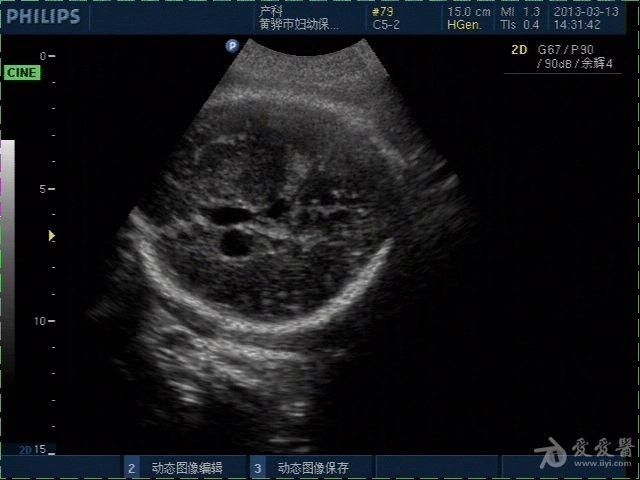 胎儿左侧侧脑室前角内囊样结构,室管膜下囊肿?