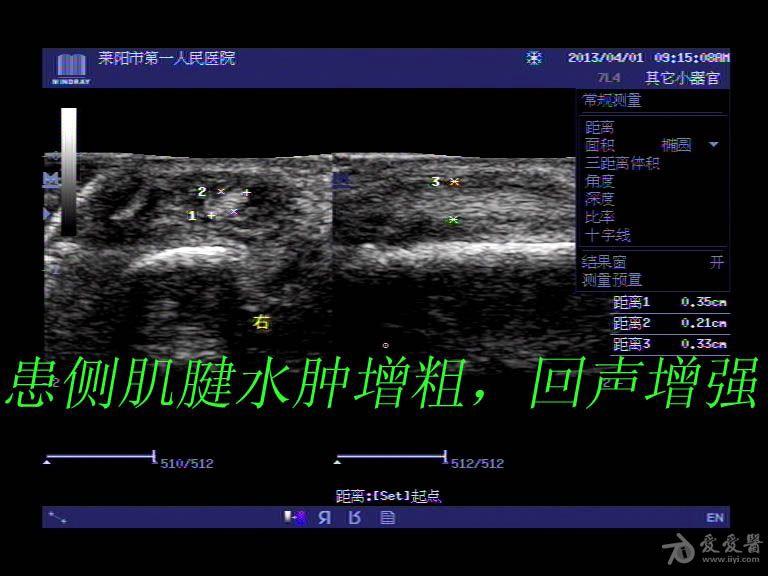 超声入门贴46-肌骨超声(腱鞘炎)