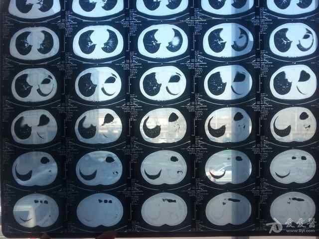 求助这张ct片的肺部异常影是什么