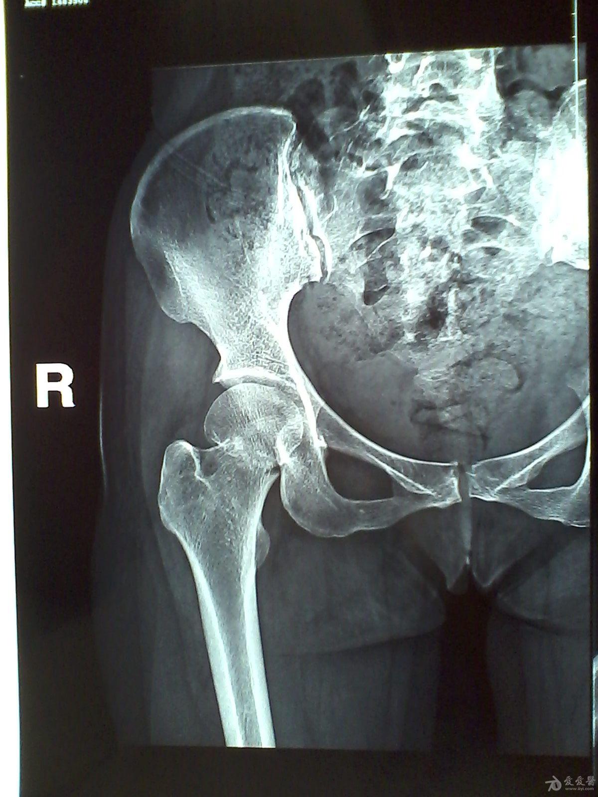 股骨颈骨折基底型图片