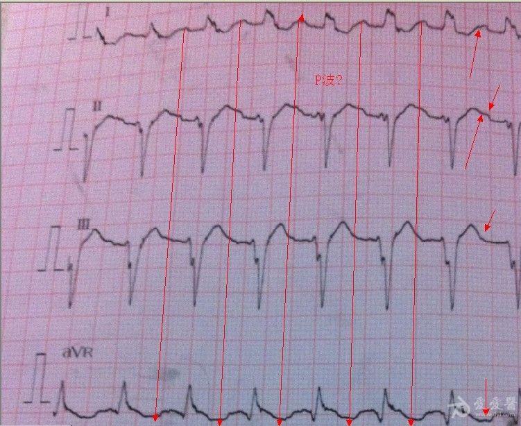 讓人糾結的心電圖
