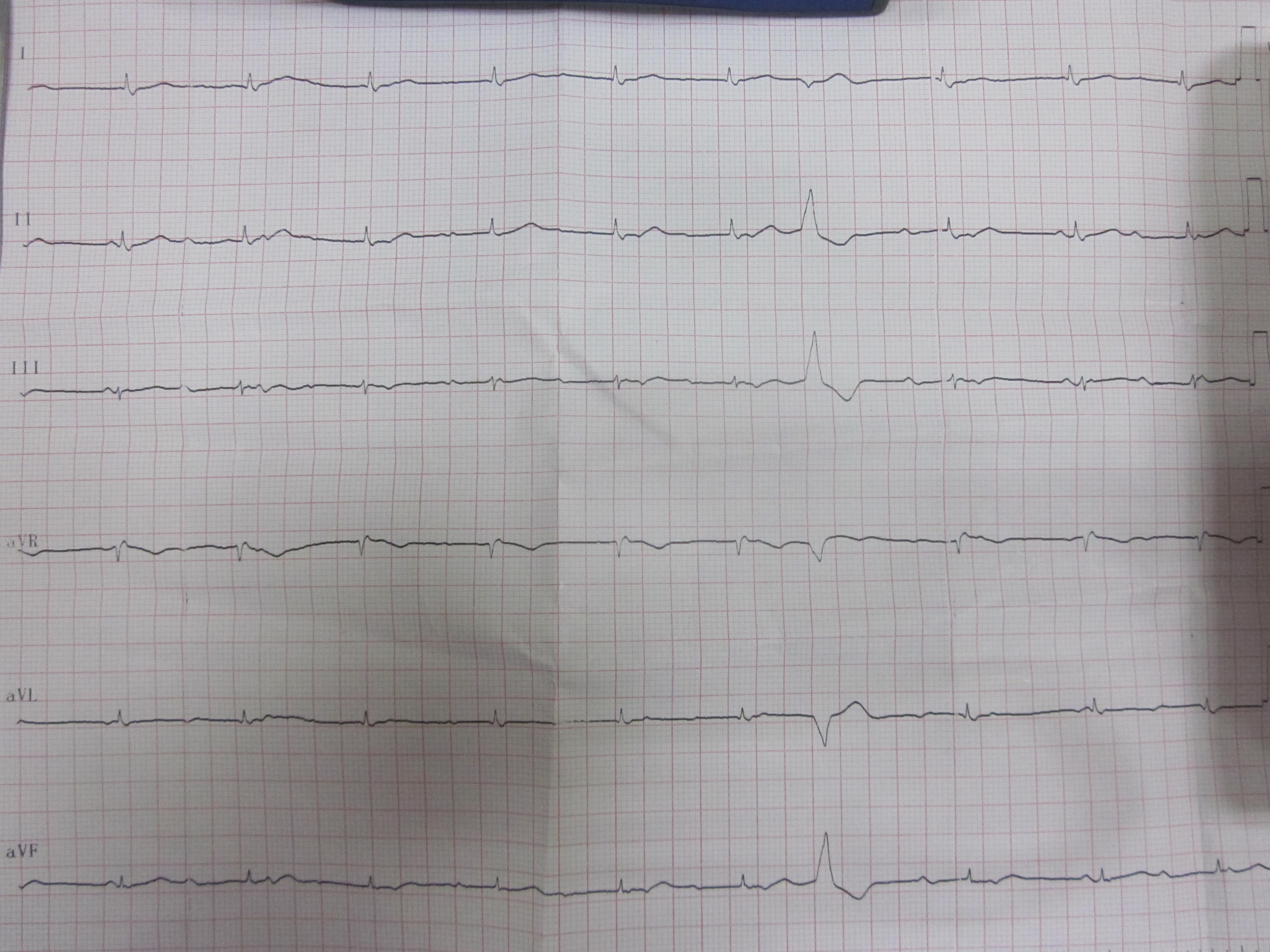 大家看看这个是不典型二度i型房室传导阻滞吗