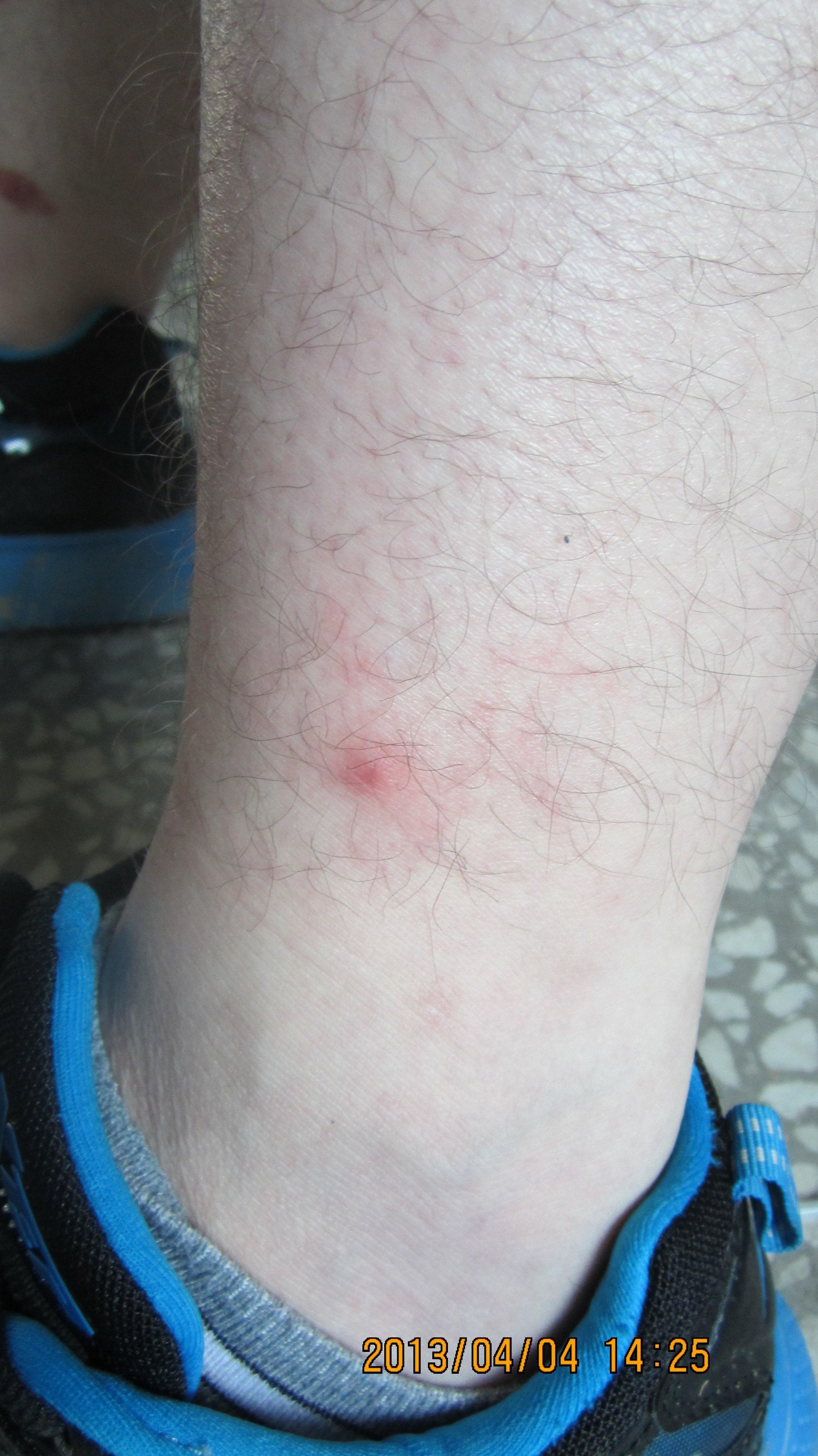 梅毒小腿症状图片图片