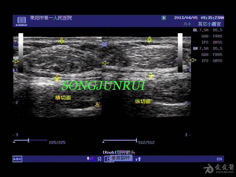 超声入门贴49-胸壁脂肪瘤