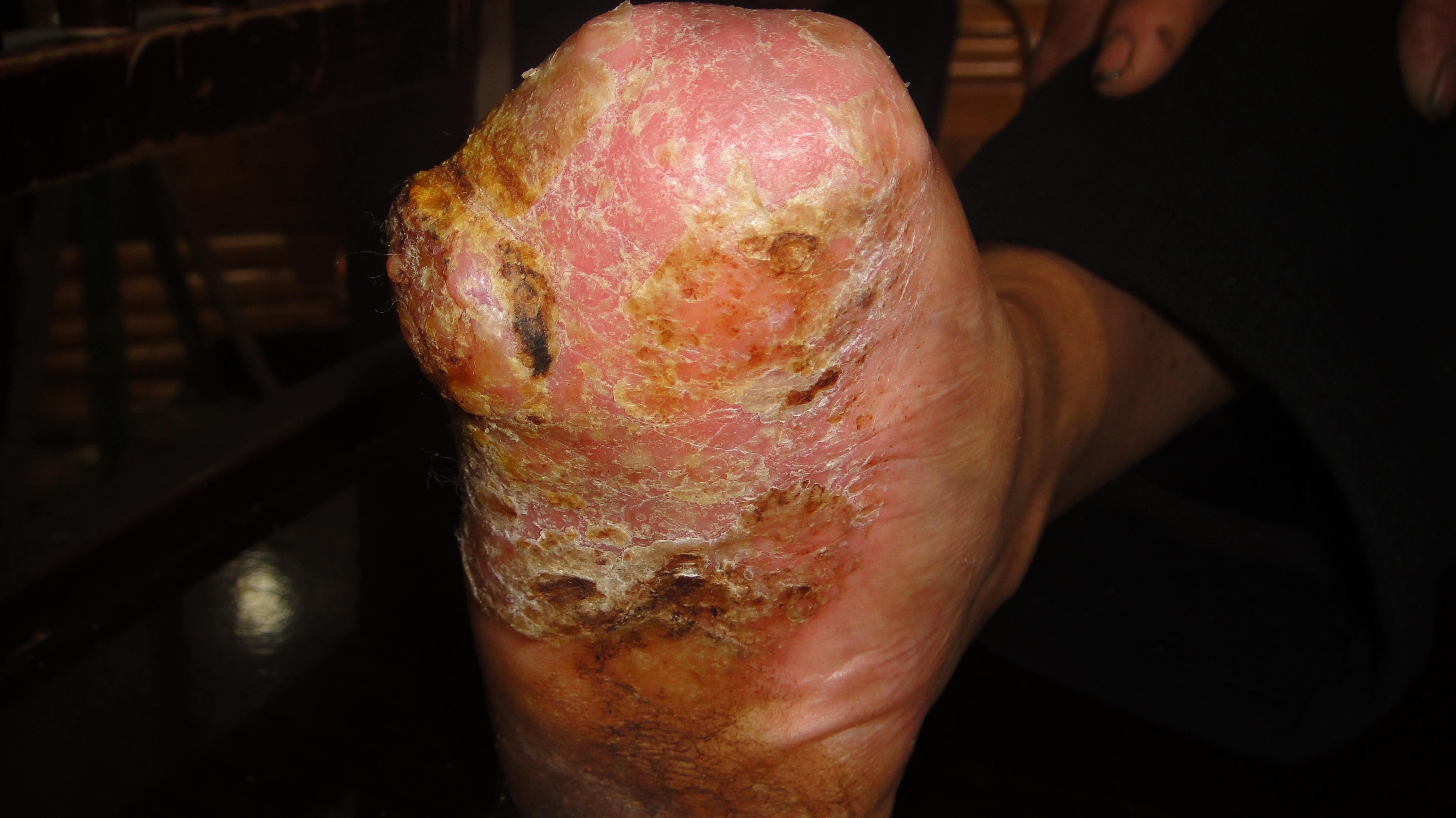 被真菌感染的皮肤图图片