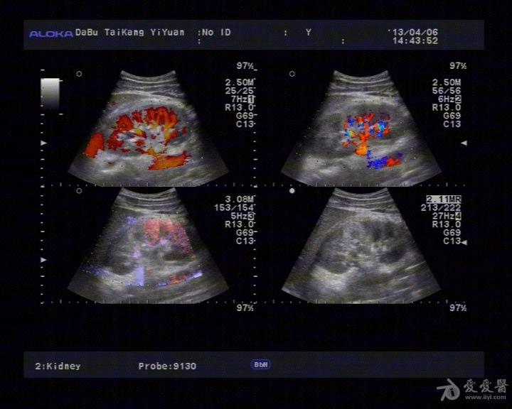 肾挫伤 - 超声医学讨论版 - 爱爱医医学论坛