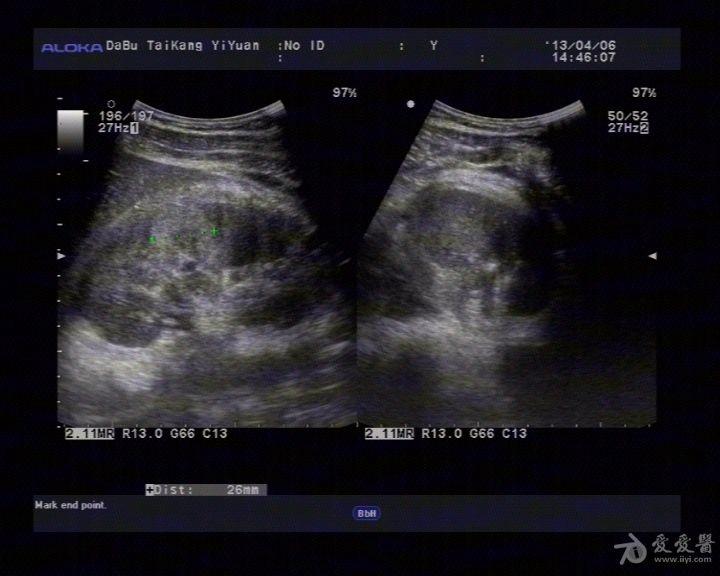 肾挫伤 - 超声医学讨论版 - 爱爱医医学论坛