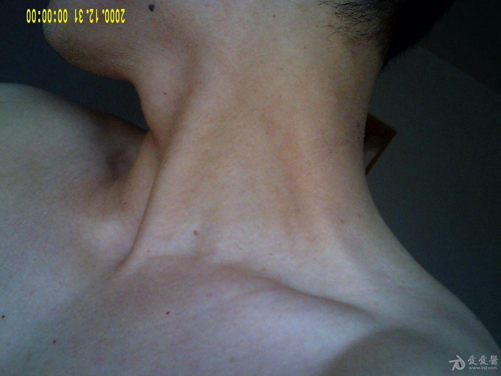 什么是黑棘皮病怎么治 1304061842616ed73a55f9a754.jpg