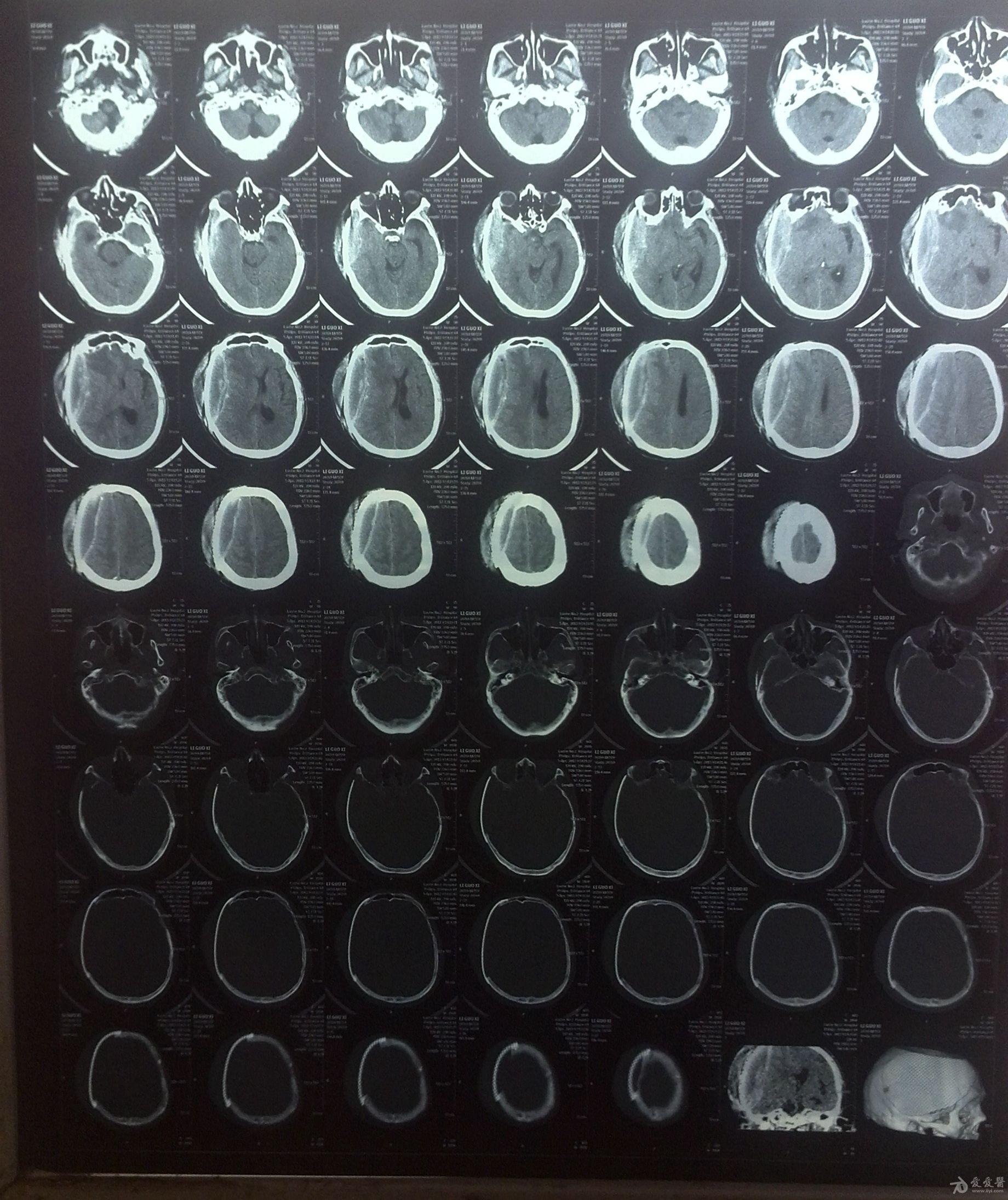 颅骨修补有死腔怎么办上图