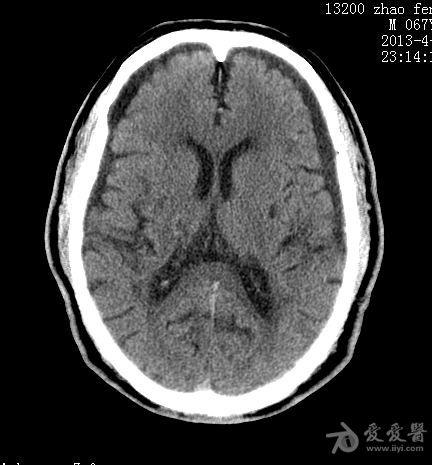 硬膜下积液表现还是脑萎缩表现?