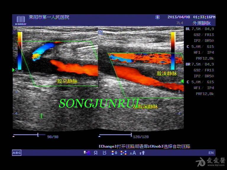 超声入门贴52下肢深静脉血栓