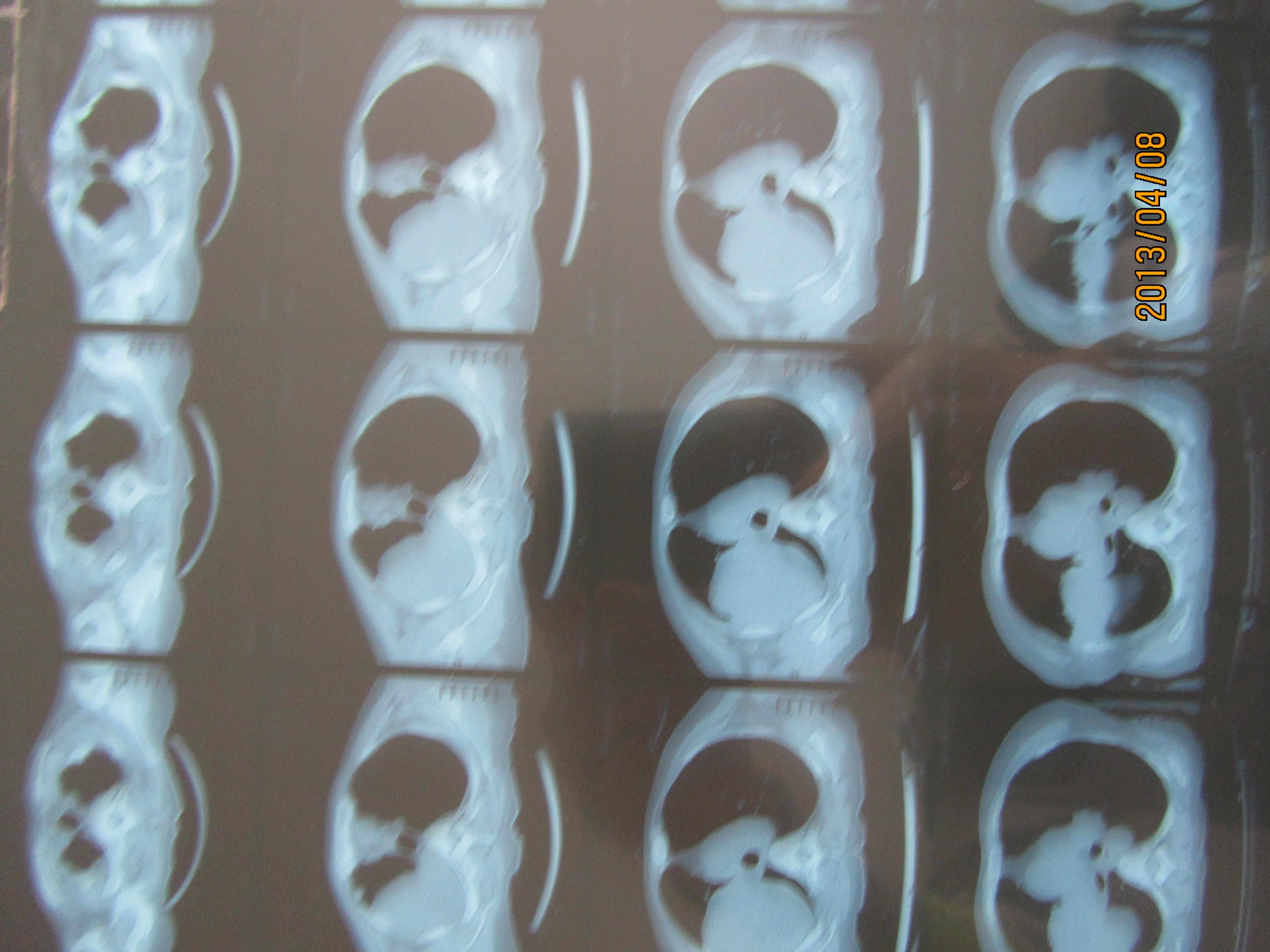 [胸外] 肺部肿瘤