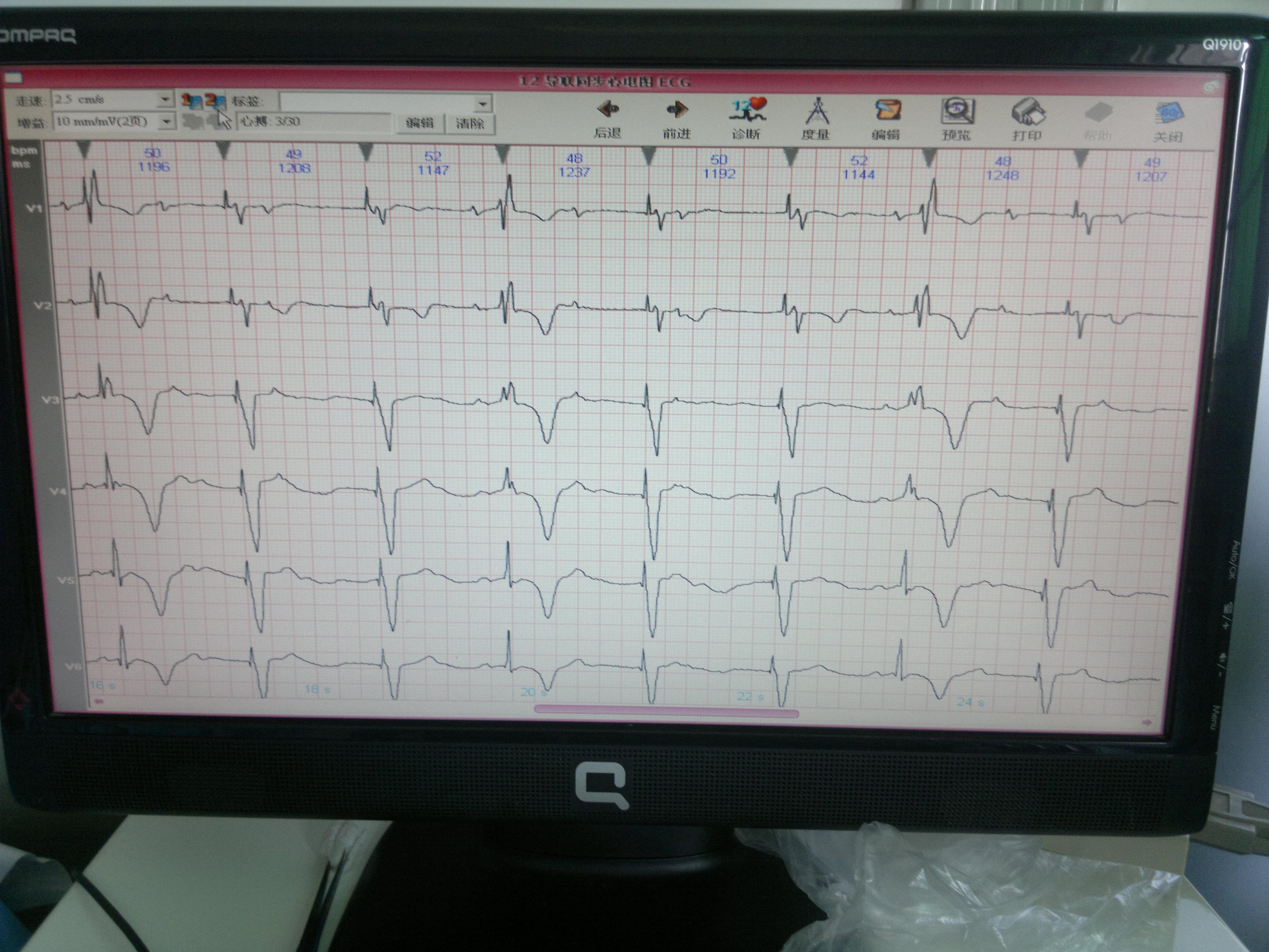 安装起搏器后心电图图片