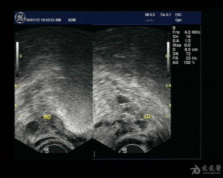 大片子宫内膜息肉图片图片