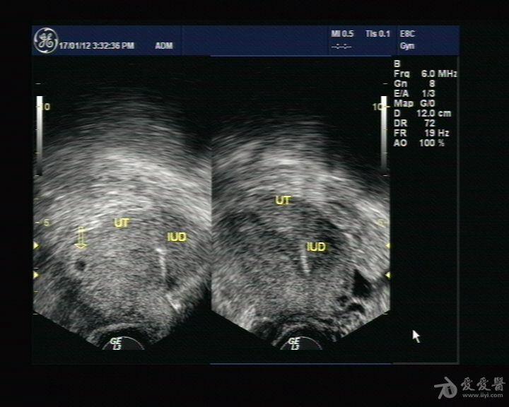 宫内节育环超声图片图片