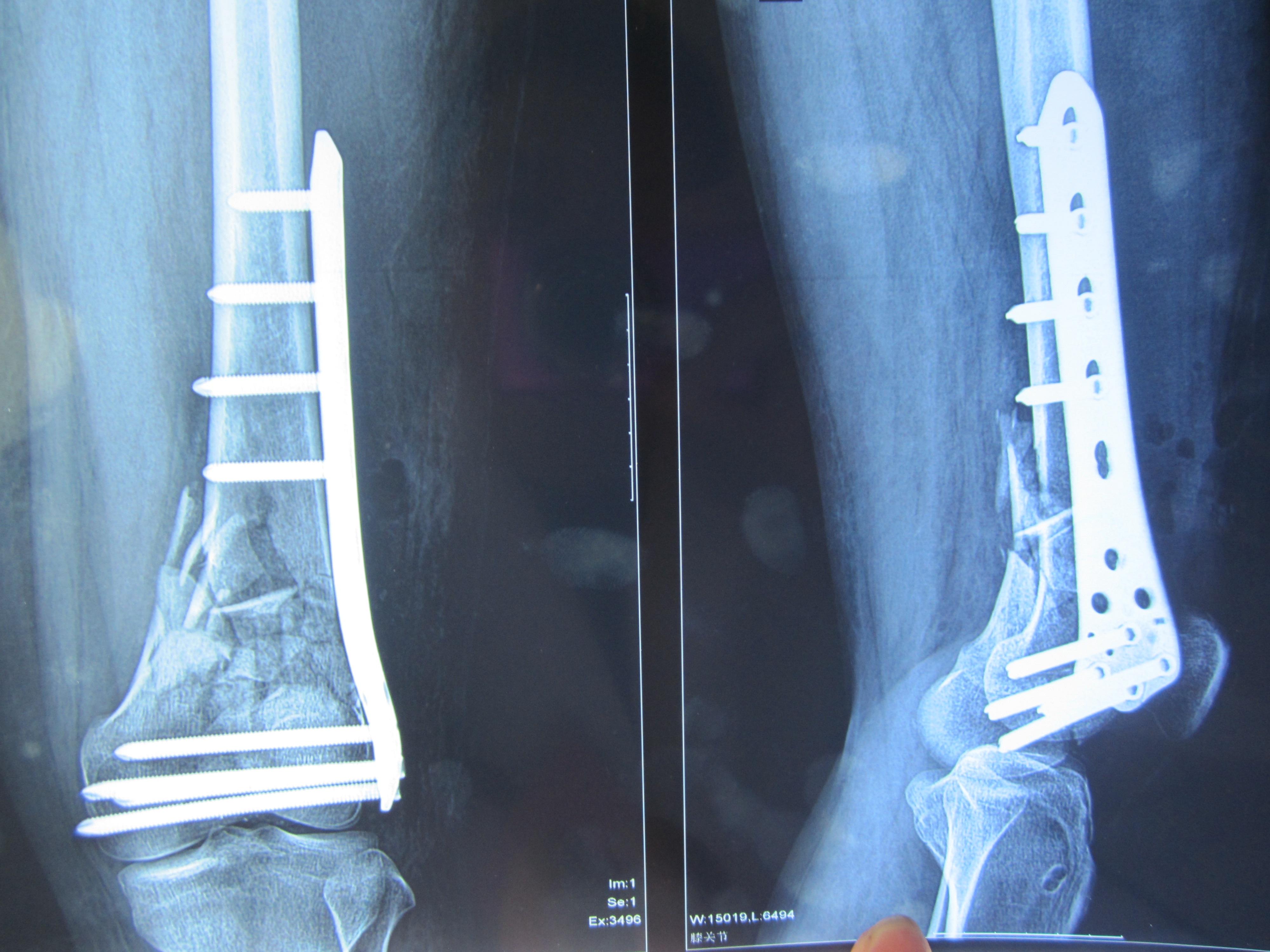 股骨远端骨折术后锁定钢板断裂