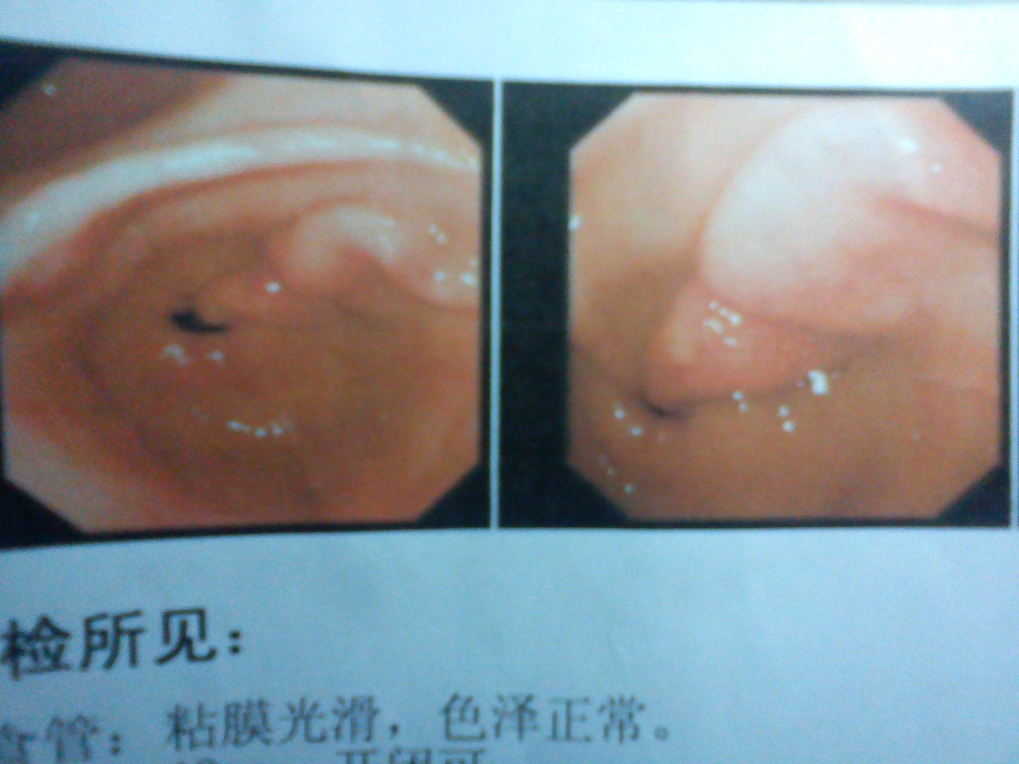 胃镜正常的贲门图片图片