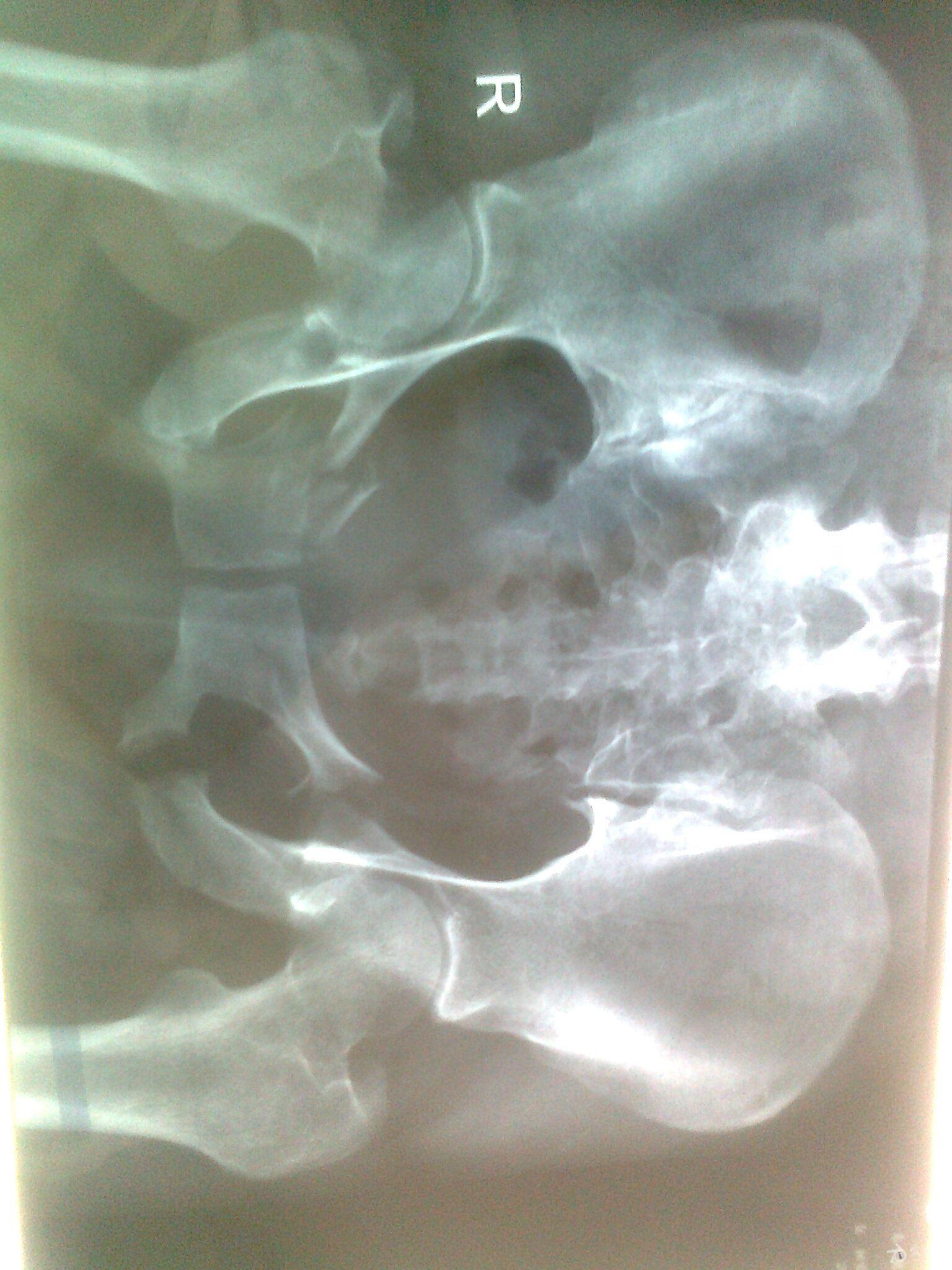 骨盆粉碎性骨折求处理方案