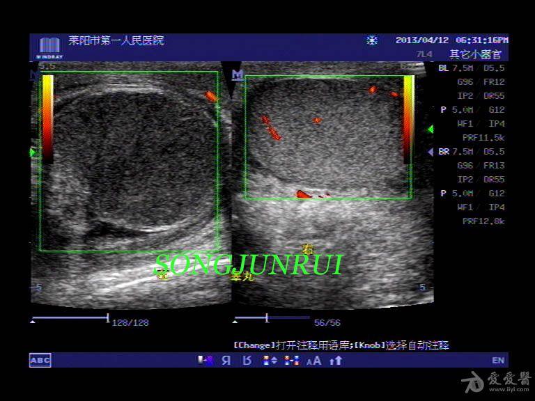 超声入门贴56睾丸扭转