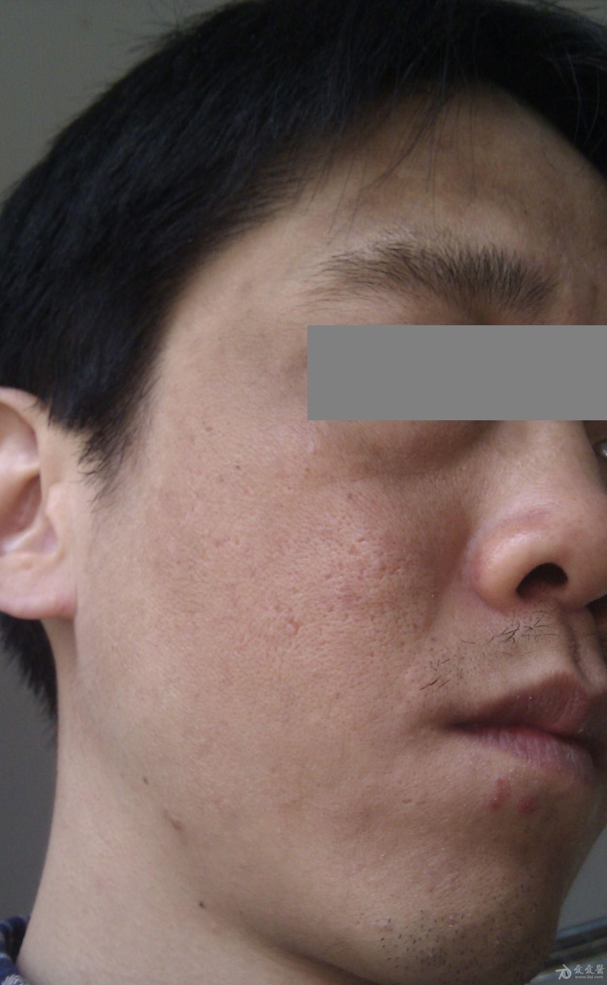 看图识病求助这是什么皮肤病