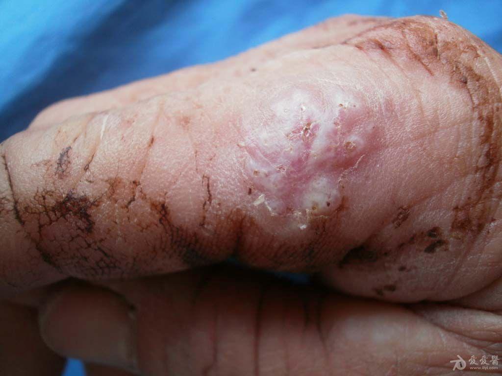 孢子丝菌病图片手指图片