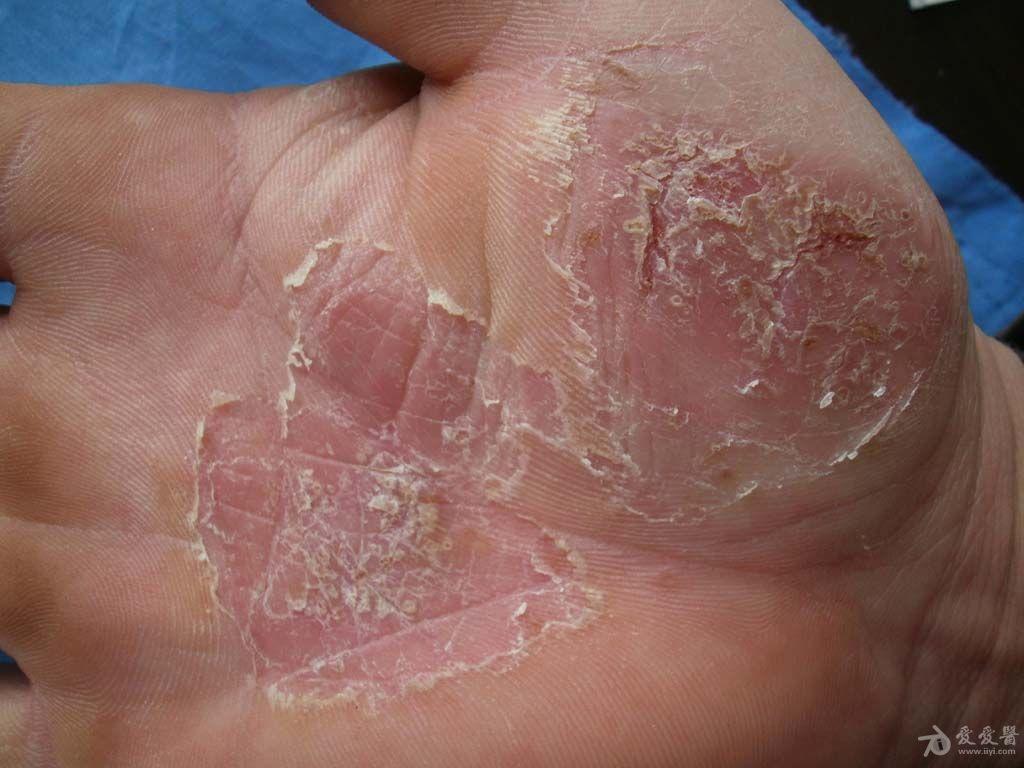 大拇指皲裂性湿疹图片图片