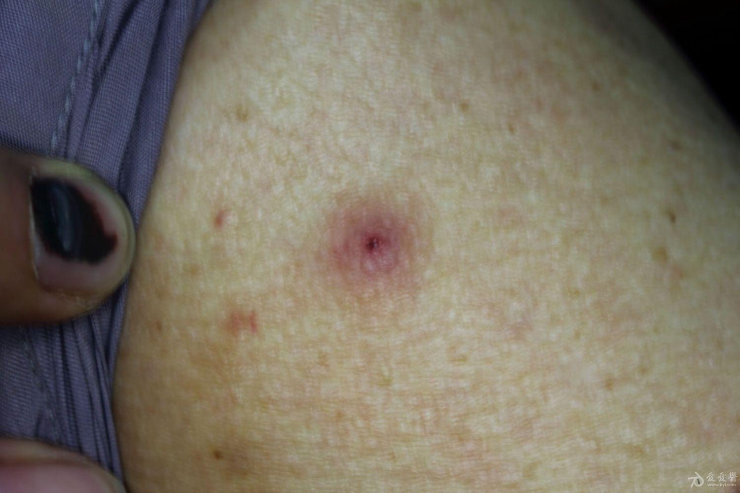 淋巴结反复增大,白细胞增高伴皮疹考虑什么病 - 皮肤及性传播疾病讨论