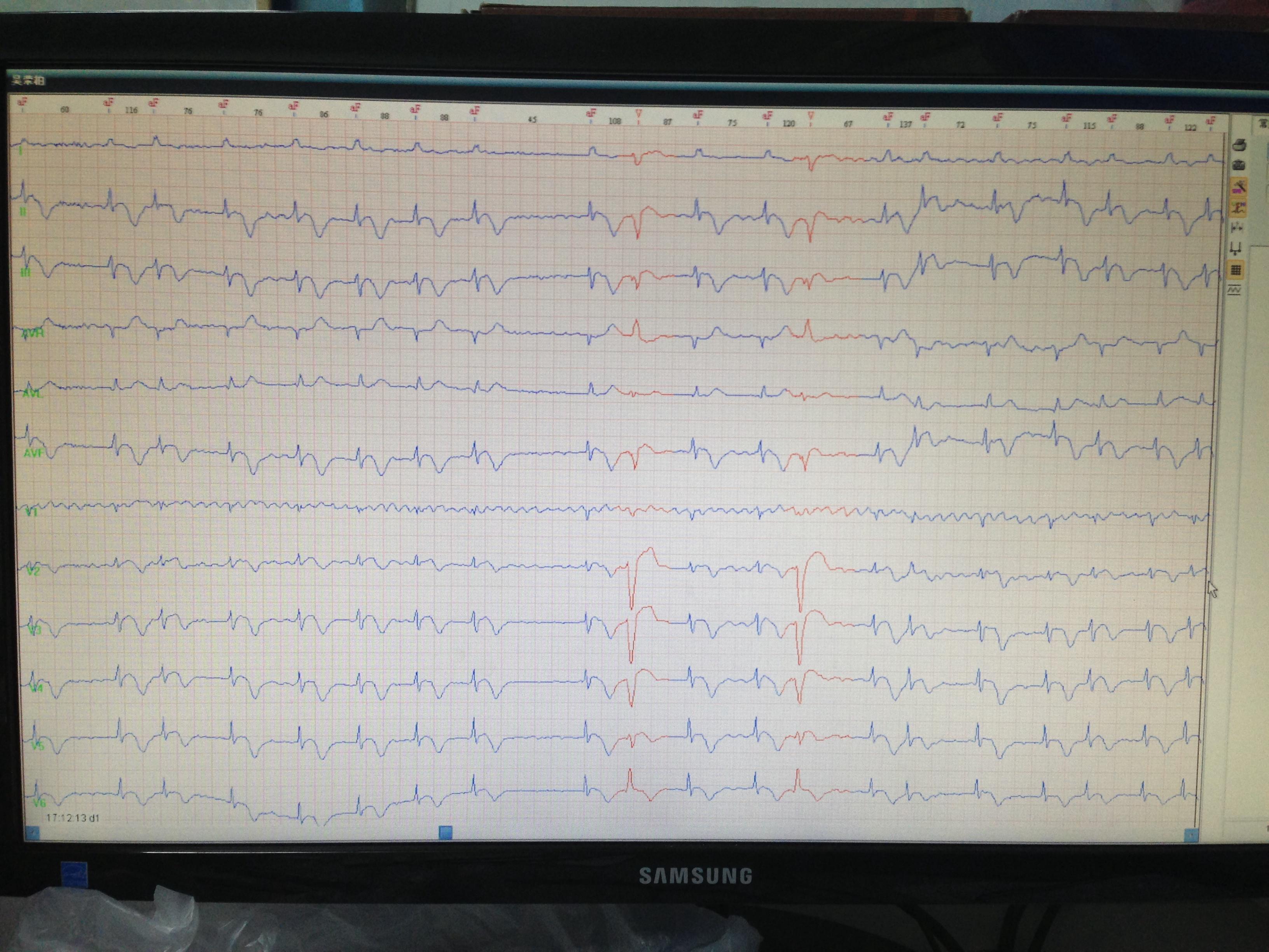 心电监护房颤波形图片图片