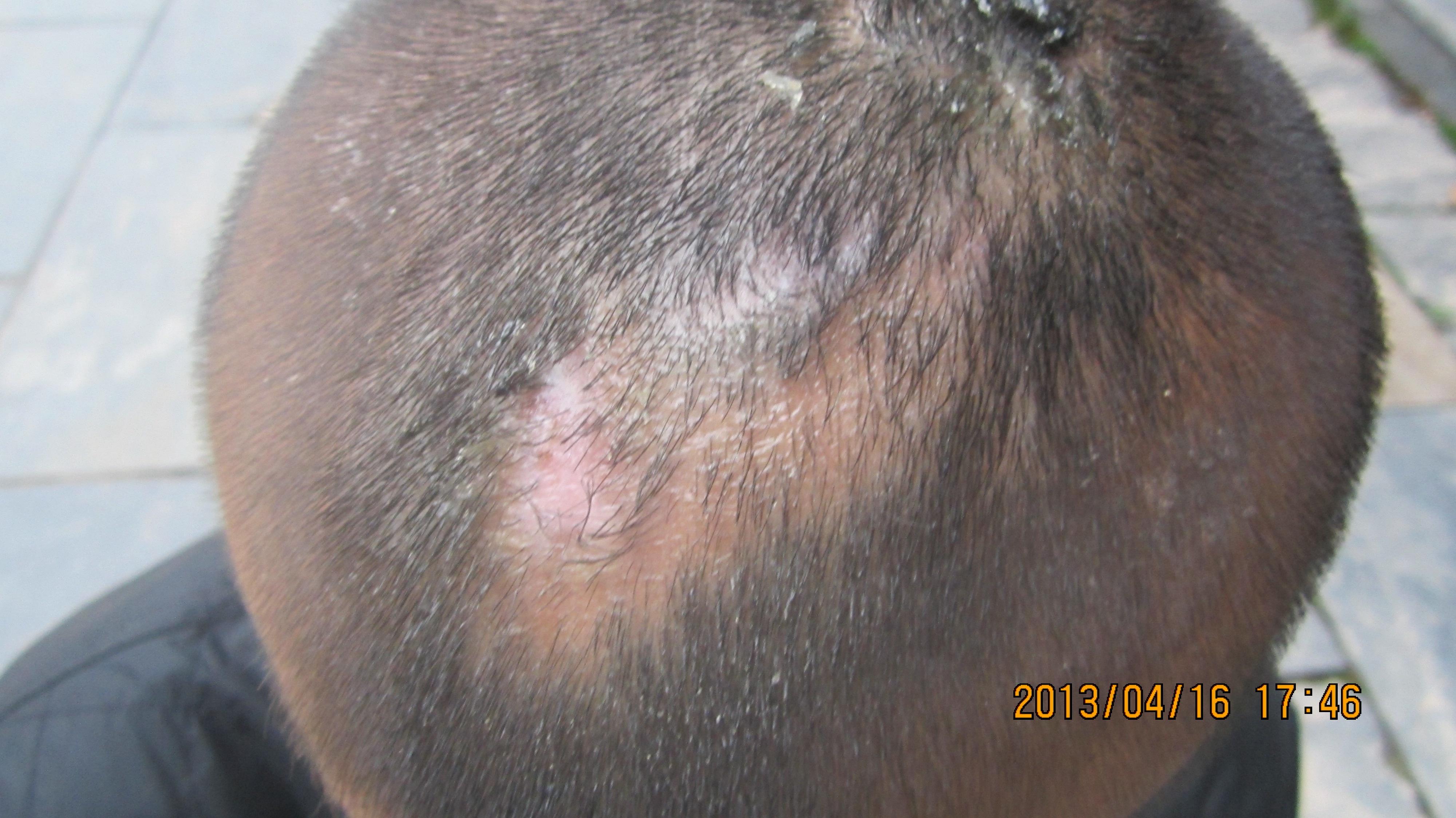 智障儿头皮皮损——《春季皮肤病病例征集》 - 全科医疗专业讨论版 - 