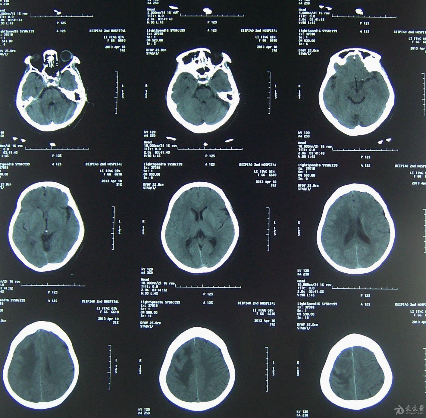 大脑凸面脑膜瘤