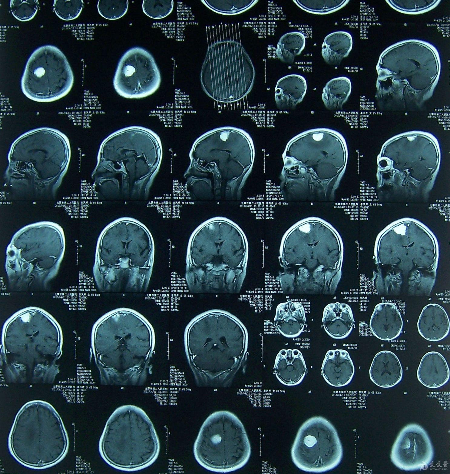 大脑凸面脑膜瘤