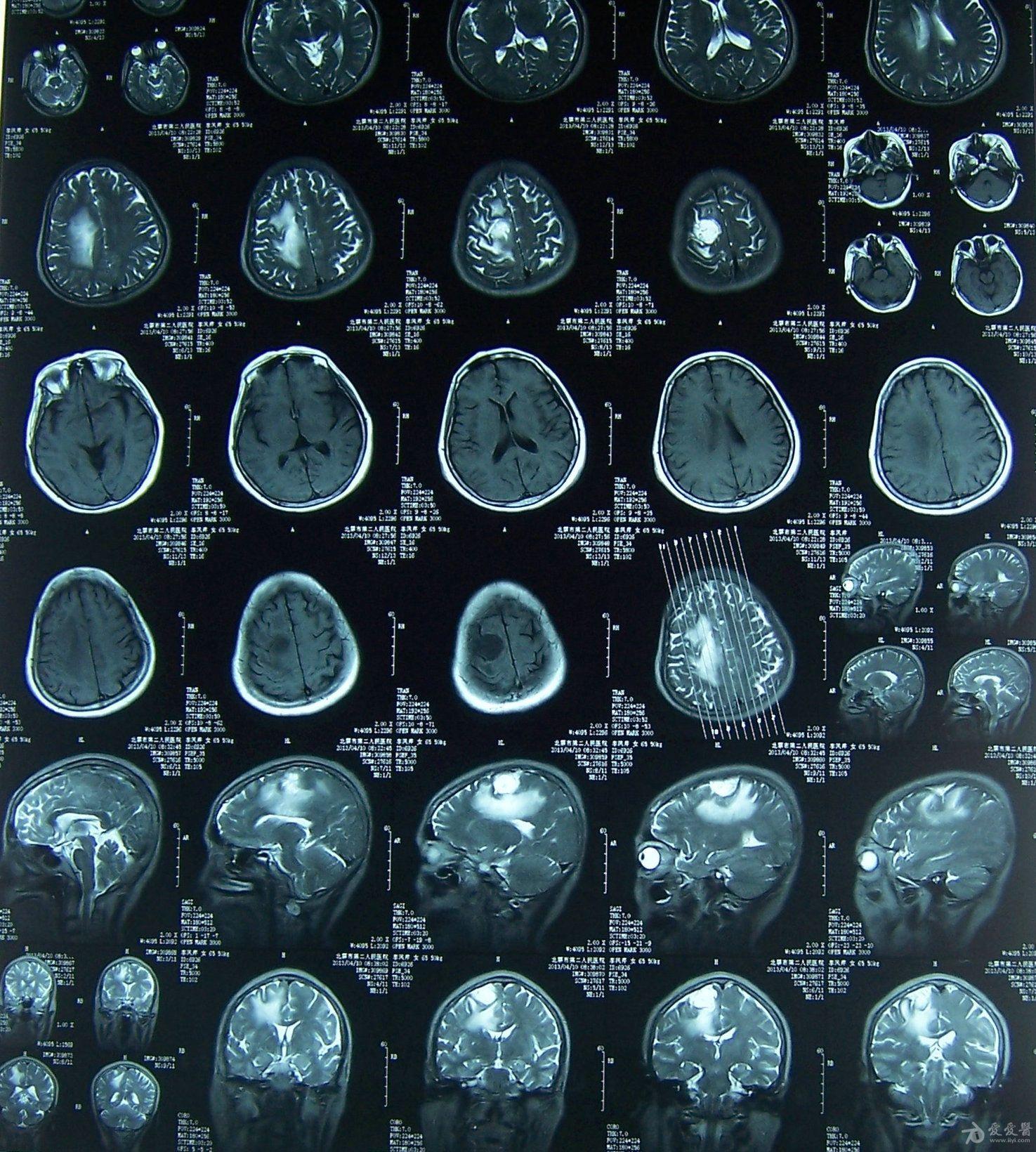 大脑凸面脑膜瘤