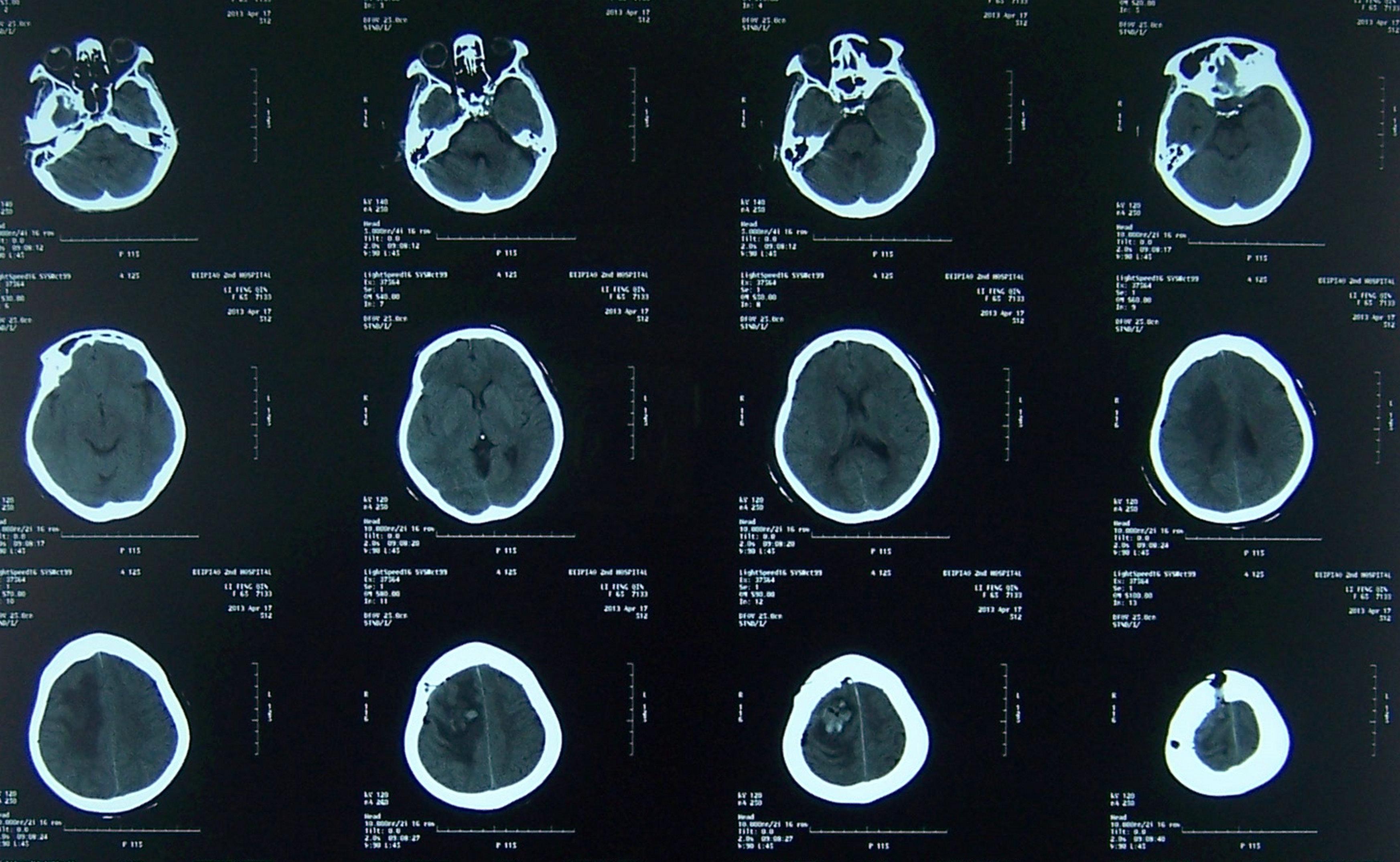 大脑凸面脑膜瘤