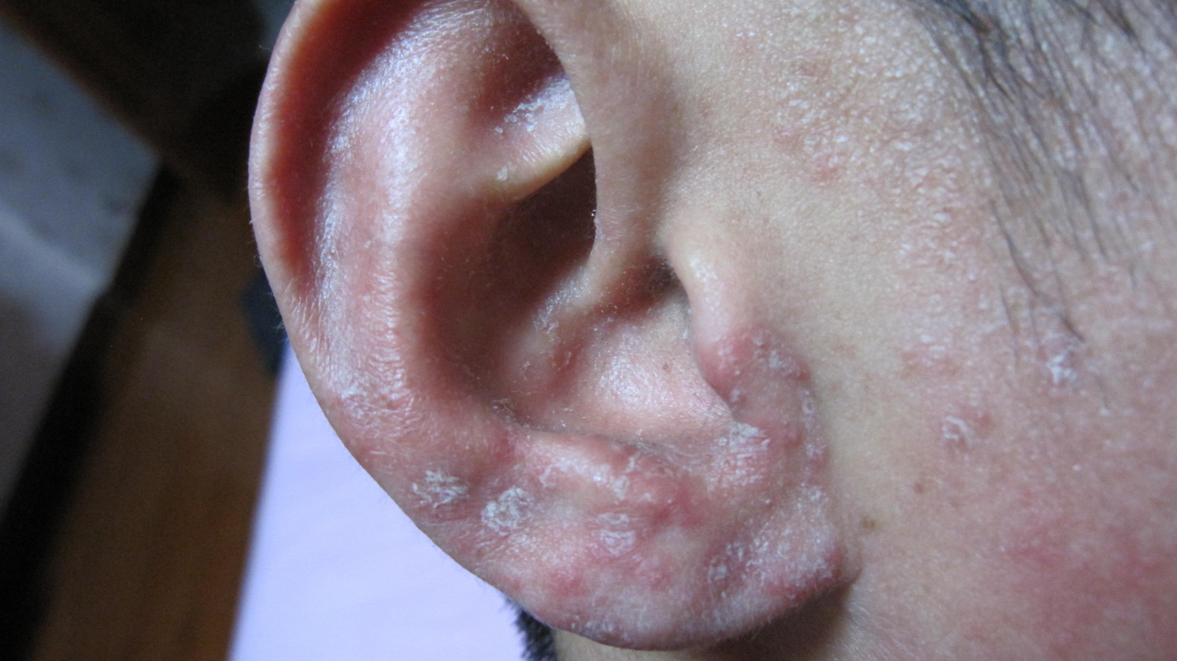 耳朵皮肤脂溢性皮炎看图