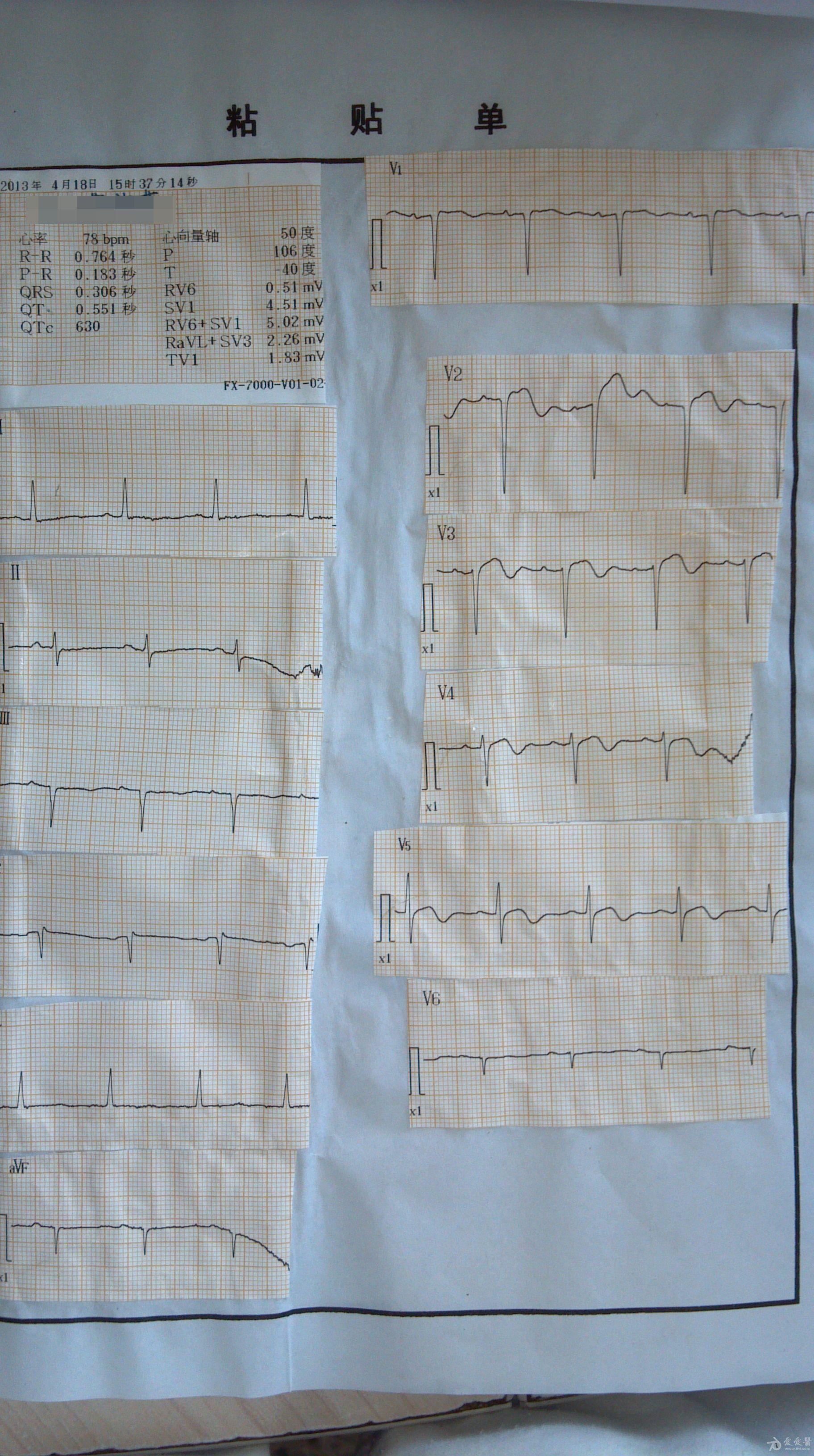 低血糖患者出现典型急性心梗心电图却无临床症状