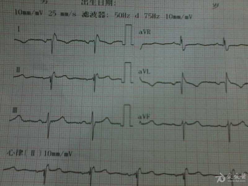 右位心? - 心电图脑电图专业讨论版 - 爱爱医医学论坛