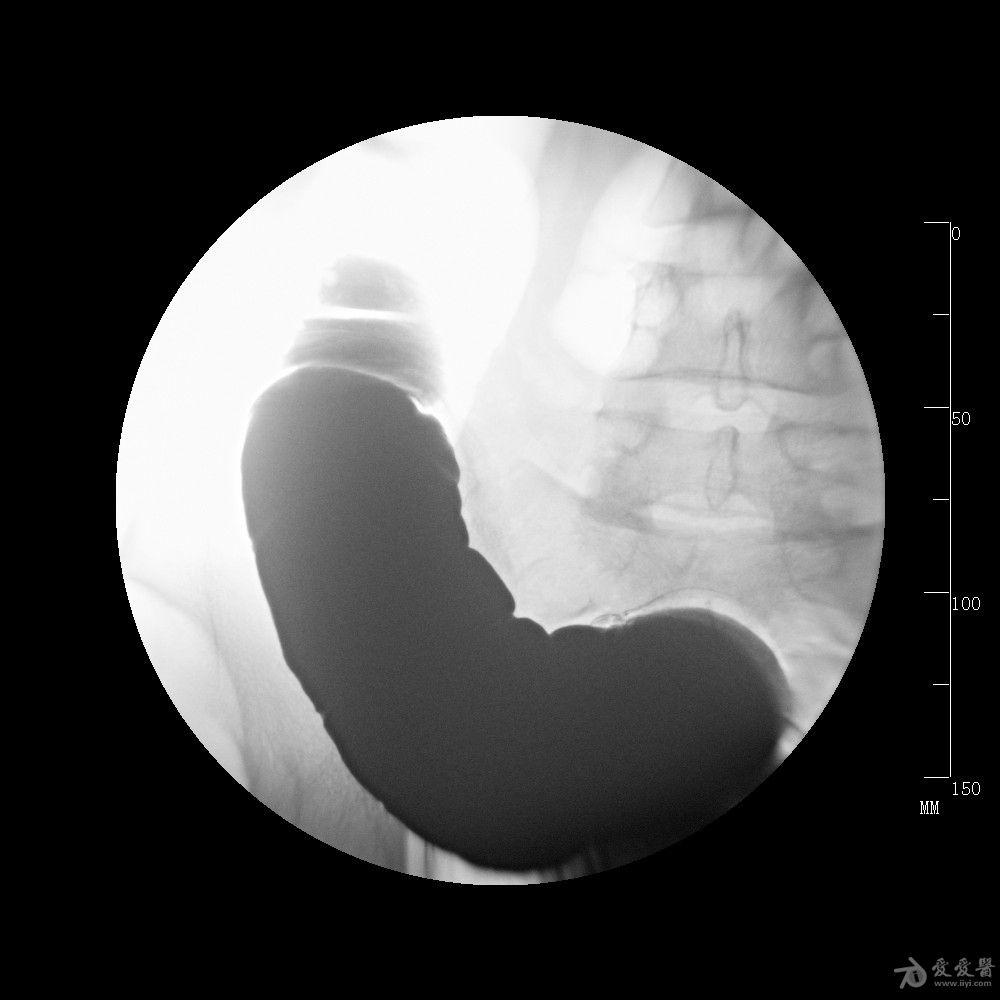 钡灌肠怀疑溃疡性结肠炎或克罗恩病