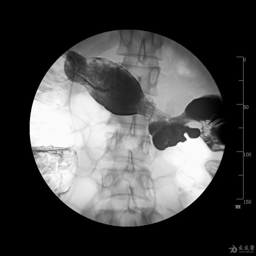 钡灌肠怀疑溃疡性结肠炎或克罗恩病