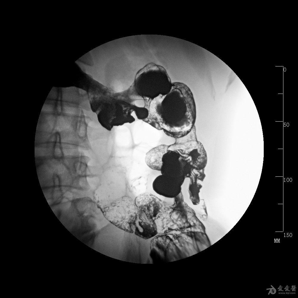 钡灌肠怀疑溃疡性结肠炎或克罗恩病