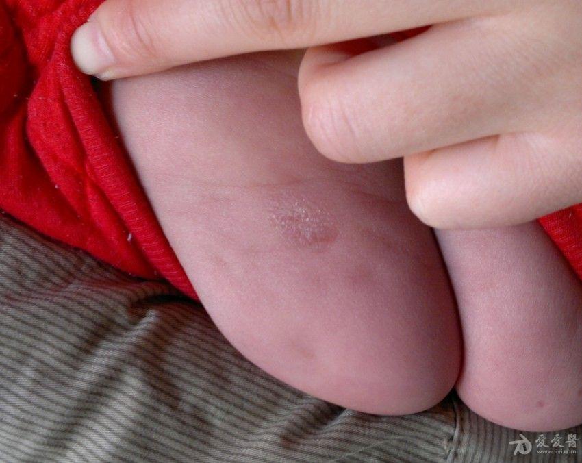 婴儿皮疹——《春季皮肤病病例征集》